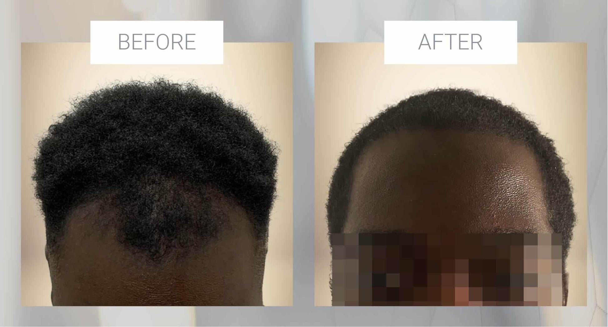 Before and after results using Pure Growth Formula for natural hair growth in African-American individuals.