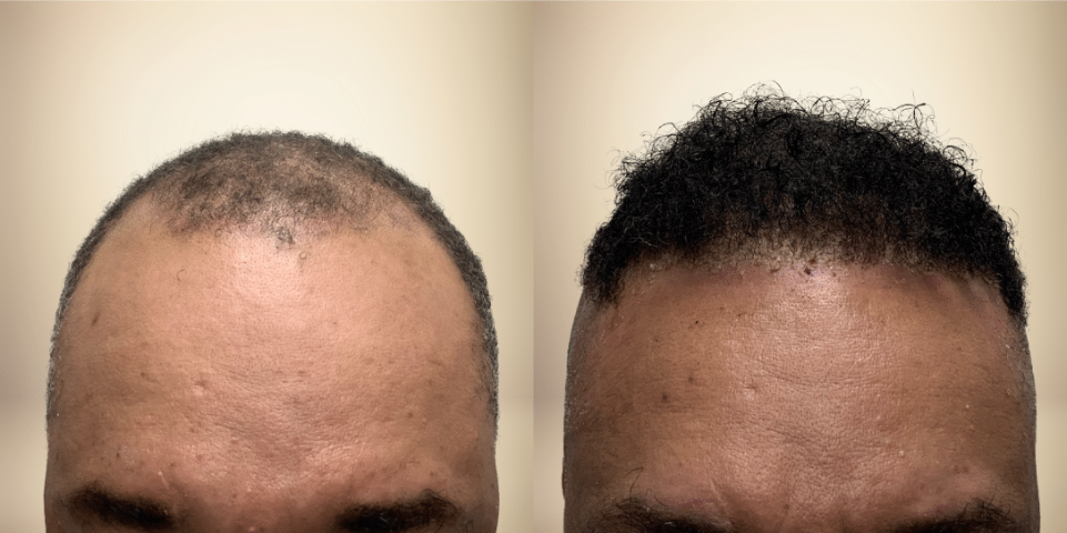 Before and after results of using Pure Growth Formula for natural hair growth.